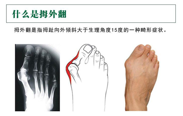 拇外翻诊室